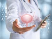 Cancro alla vescica, approvato rimborso per immunoterapia prima e dopo chirurgia