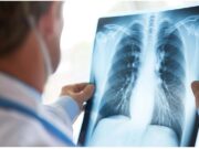 Cancro al polmone, approvato il rimborso di 2 nuove indicazioni per durvalumab