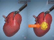 Modelli tridimensionali biomimetici del cancro al rene di un paziente per chirurgia robotica sempre più precisa