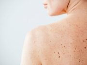 Nei e sole, Sidemast lancia la Giornata della prevenzione dermatologica