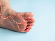 Asl Roma 4, presentato nuovo Pdta per neuropatia diabetica dolorosa